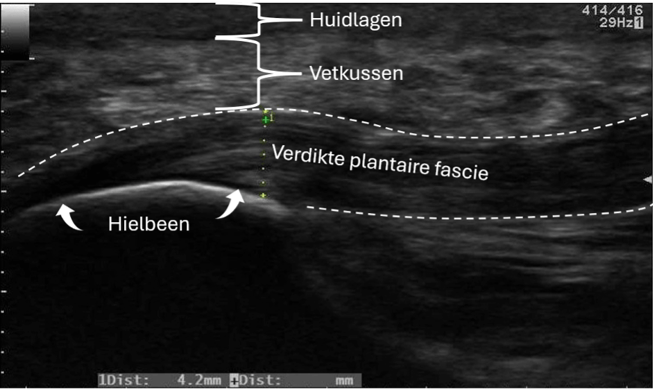 Echografie van de plantaire fascie en het vetkussen van de hiel