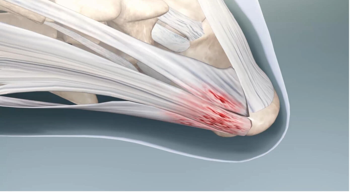 Visible body – Plantaire Fasciitis Visible body – Plantaire Fasciitis